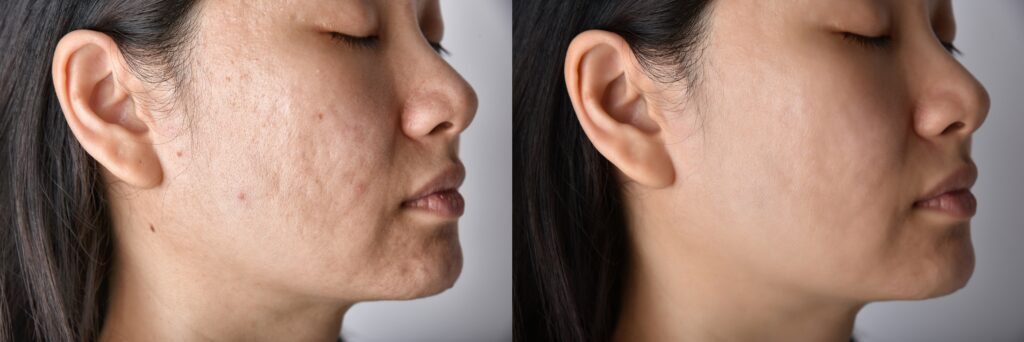 Skin problems and acne scar, Before and after acne facial care treatment, Beauty concept.